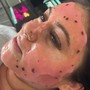 Dermaplaning