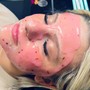 Dermaplaning