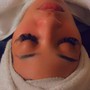 Acne Facial