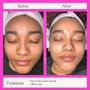 Back Facial Treatment