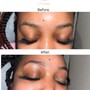 Acne Facial