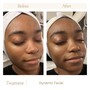 Dynamic Acne Facial