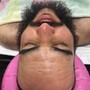 Microdermabrasion Facial