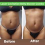 Cellulite Reduction Treatment