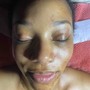 Acne Facial