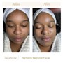 Dynamic Acne Facial