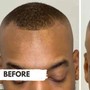 Scalp Micropigmentation