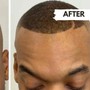 Scalp Micropigmentation