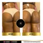 BUTT ENHANCEMENT/LIFTING