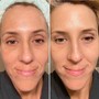 Microneedling (Face)