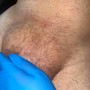 Tweezing ingrown hair's (beard)