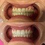 Teeth Whitening Intro (1 session)