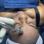 Microdermabrasion