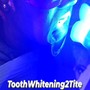 Teeth Whitening