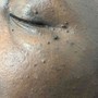 Microdermabrasion