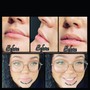 Lip Fillers- Juvéderm, Restylane Kysse and so many other brands for lips