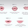 Lip Fillers- Juvéderm, Restylane Kysse and so many other brands for lips