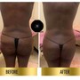 BUTT ENHANCEMENT/LIFTING