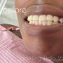 2 Year Coverage Sparkling Halo Veneers in-house Insurance (maintenance/ chips/ broken or missing veneers)