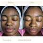 Dermaplaning Facial