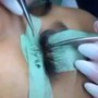 Dermaplaning