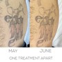 Laser Tattoo Removal On Small Area 5cmx10cm