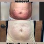 Cryo fat freezing and reduction