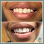 60 Min Teeth Whitening and 1 Gem SPECIAL*