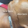 DPN/Skin Tag/Milia Removal 45 minutes