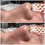 Microdermabrasion