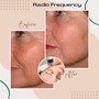 Radio Frequency Tone/Tightening