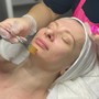 Microdermabrasion