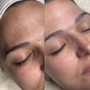 Diamond Hydrofacial