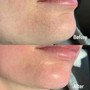 Facial tightening