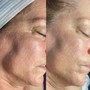 Hydra facial