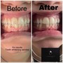 Teeth Whitening