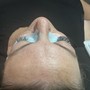 Dermaplaning