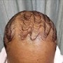 Itchy Scalp Treatment