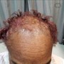 Itchy Scalp Treatment