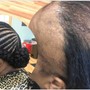 Consultation” Severe HairLoss”