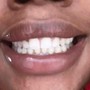 Top or bottom 6 teeth