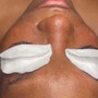 Microdermabrasion