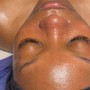 Microdermabrasion