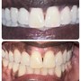 Teeth Whitening