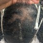 Alopecia Enhancement