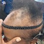 Alopecia Enhancement