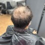 Men's Hair Restoration