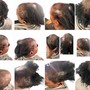 Alopecia hair loss braids