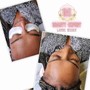 Acne Facial Extractions