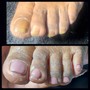 Toenail reconstruction/ pedicure/ no acrylic